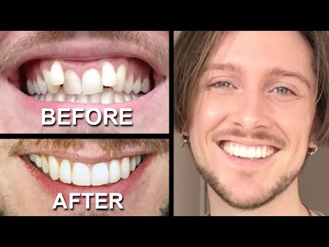 INVISALIGN REVIEW - everything you need to know