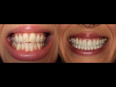 Invisalign Time Lapse UPDATED!