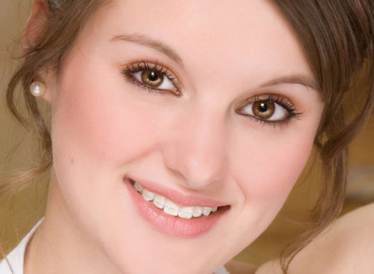 Clear braces