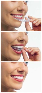 invisalign experience