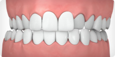 image of a crossbite