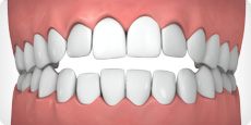 image of an open bite