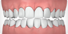 image of crowded teeth