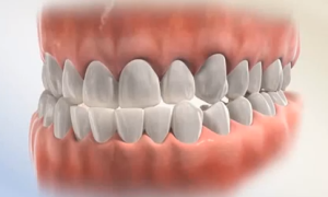 bite problem
