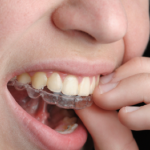 clear-aligners