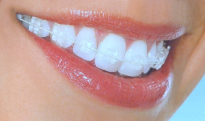 clear braces
