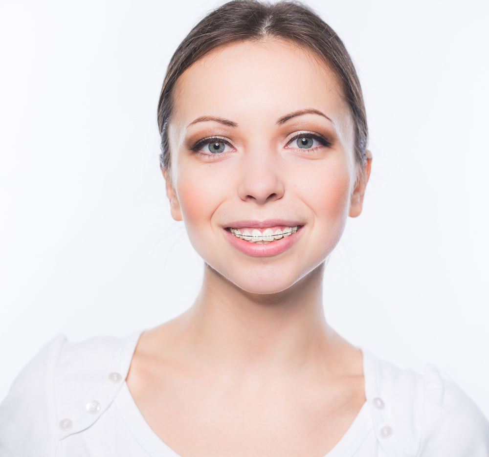 braces financing