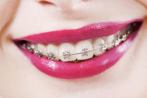 woman wearing traditional braces