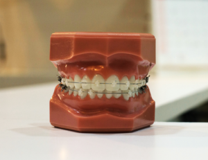 ceramic braces on a mold