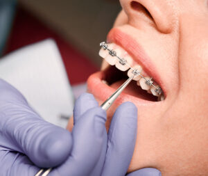 Close up of dentist hand in serial glove putting elastic rubber band on patient brackets. Woman with wired metal braces on teeth receiving orthodontic treatment in dental clinic. Concept of dentistry.