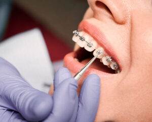 Close up of dentist hand in serial glove putting elastic rubber band on patient brackets. Woman with wired metal braces on teeth receiving orthodontic treatment in dental clinic. Concept of dentistry.
