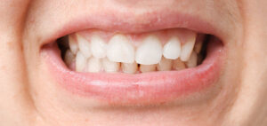 Mouth showing a malocclusion.