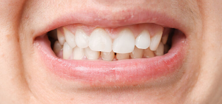 Mouth showing a malocclusion.