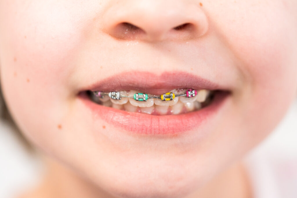 Little girl with rainbow braces