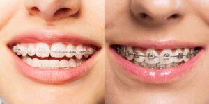 clear vs metal braces
